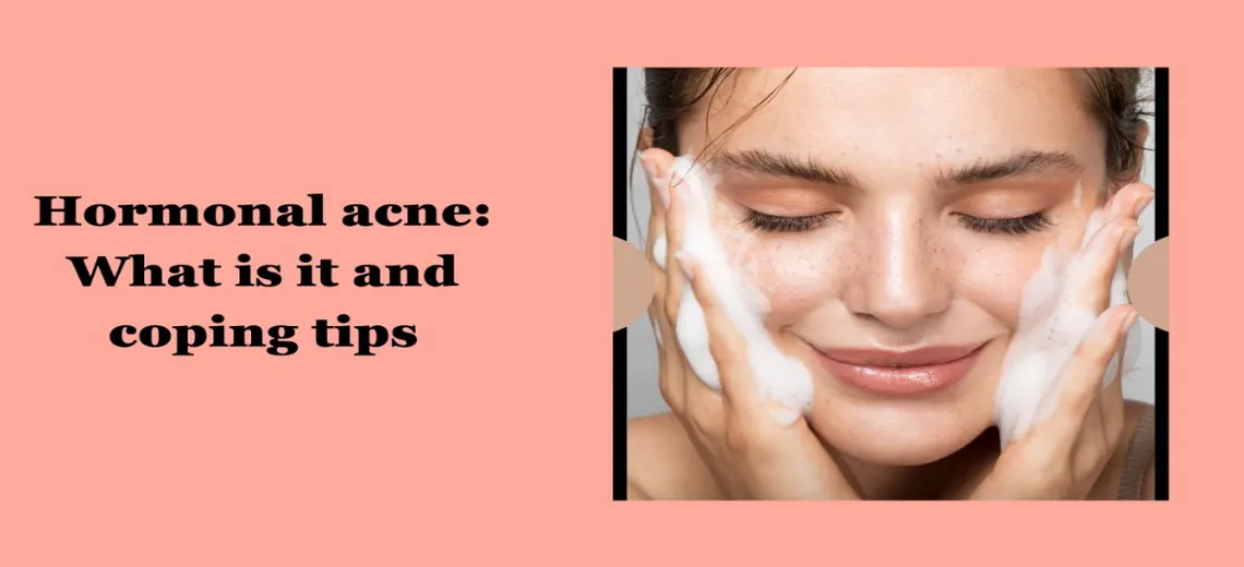 Hormonal acne tips