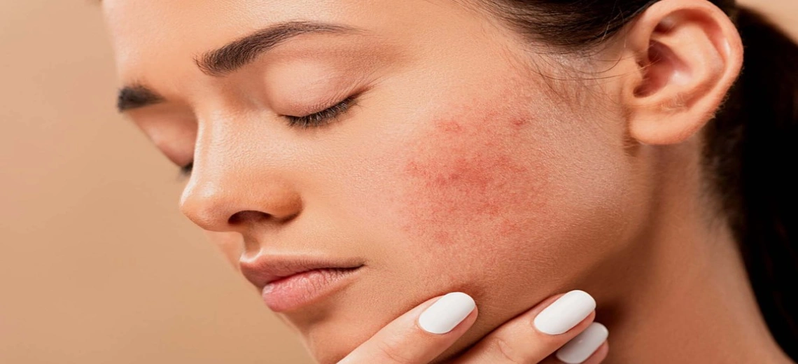 how to remove whiteheads