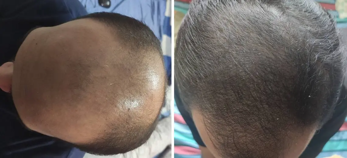 Traya Best Hair Treatment
